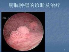 膀胱肿瘤的诊断及治疗ppt课件