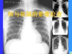 肺和纵隔的影像检查ppt课件