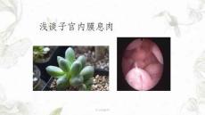 子宫内膜息肉课件
