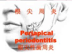 《根尖周炎》ppt课件