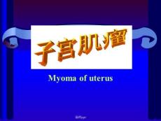 《子宫肌瘤》