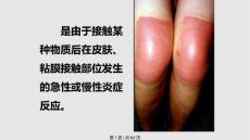 接触性皮炎学习
