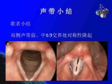 声带息肉声带小结人卫第八版ppt课件