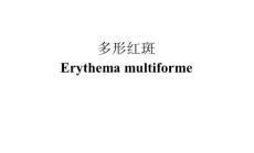 《皮肤病》多形红斑