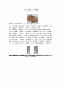 类风湿性关节炎21521
