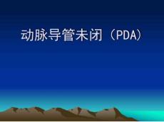 动脉导管未闭pda