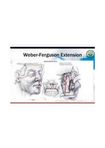 上頜骨切除術(shù)Weber-Ferguson Extension