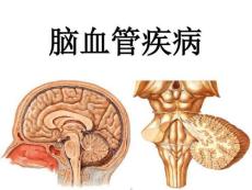 脑血管病课件