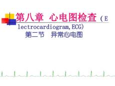 异常心电图心肌缺血心肌梗死