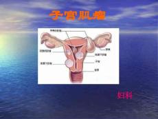 子宫肌瘤课件