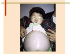 小儿泌尿肾病PPT课件
