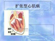 扩张型心肌病查房