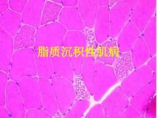 脂质沉积性肌病