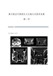 鼻内镜治疗鼻腔乳头状瘤术后脑脊液鼻漏一例
