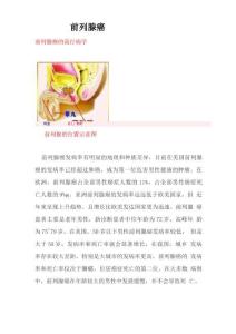 前列腺癌科普文章