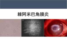 棘阿米巴角膜炎课件
