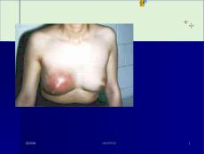乳痈作品