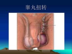 睾丸扭转17241