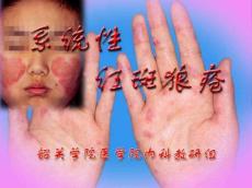 系统性红斑狼疮11784