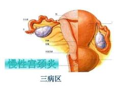 慢性宫颈炎