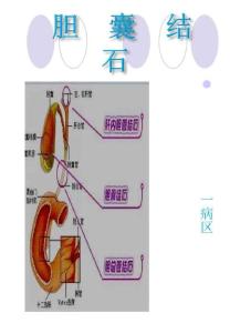 胆结石动画