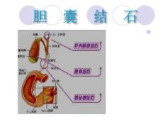 胆囊结石护理