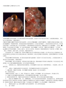【精品】多囊肾综述