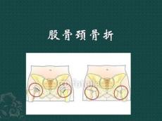 股骨颈骨折