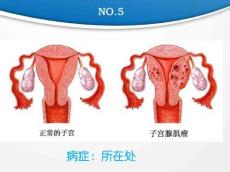 子宫肌瘤10666