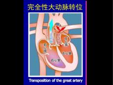 《儿科》完全性大动脉转位