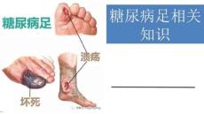 糖尿病足知识