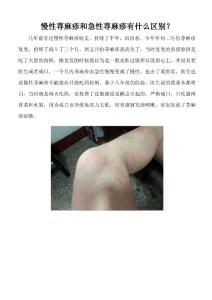 慢性荨麻疹与急性荨麻疹,一招轻松搞定