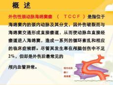 颈内动脉海绵窦瘘常用文档38519