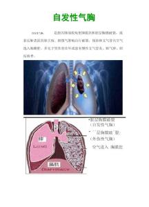 自发性气胸相关知识