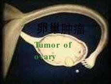 卵巢肿瘤课件