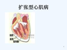 扩张型心肌病查房课件