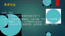食管憩室的超声诊疗和鉴别诊疗ppt课件
