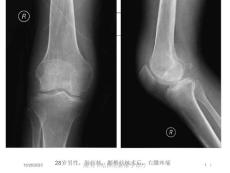 膝关节结核的影像学诊疗培训ppt课件