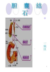 胆囊结石课件