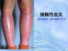 接触性皮炎ppt课件