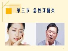 《急性牙髓炎》课件