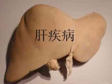 称为肝脓肿课件