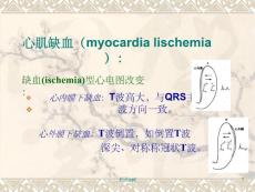 心肌缺血心电图课件