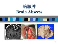 脑脓肿课件