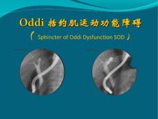 Oddi括约肌运动功能障碍.ppt