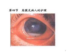 角膜炎病人护理课件