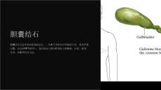 《胆囊结石》课件
