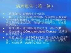皮质纹状体脊髓变性课件