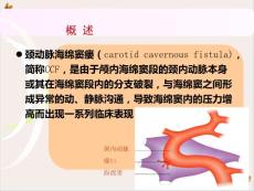 颈内动脉海绵窦瘘的诊治课件
