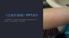 《过敏性紫癜》课件